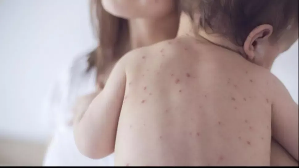 Rujeola lovește din nou România. Avertisment pentru cei care refuză vaccinarea: „Poate fi responsabil pentru sănătatea unui copil”